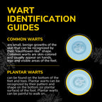 Freeze Away Max™ Wart Remover