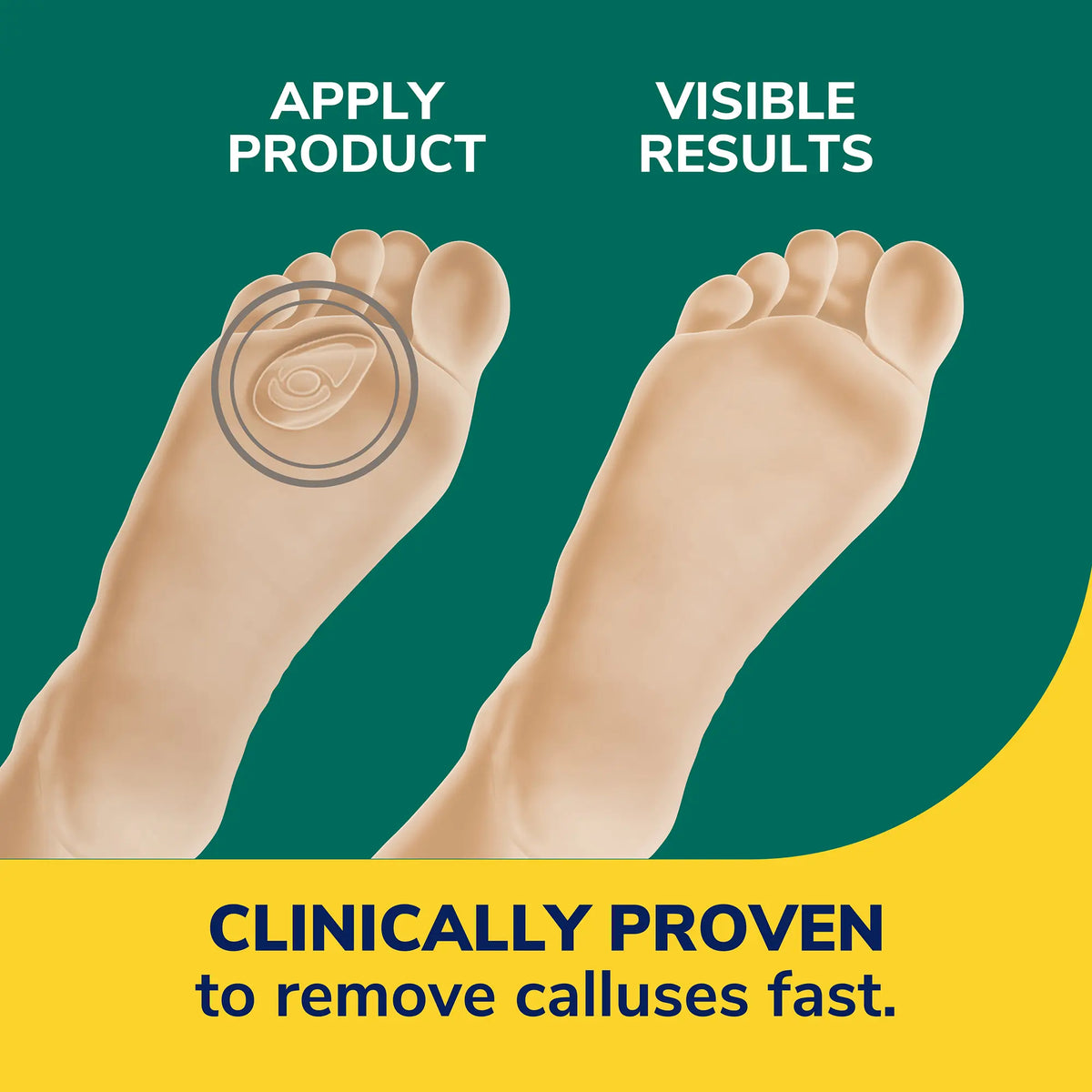 Callus Removers Seal & Heal Bandage with Hydrogel Technology