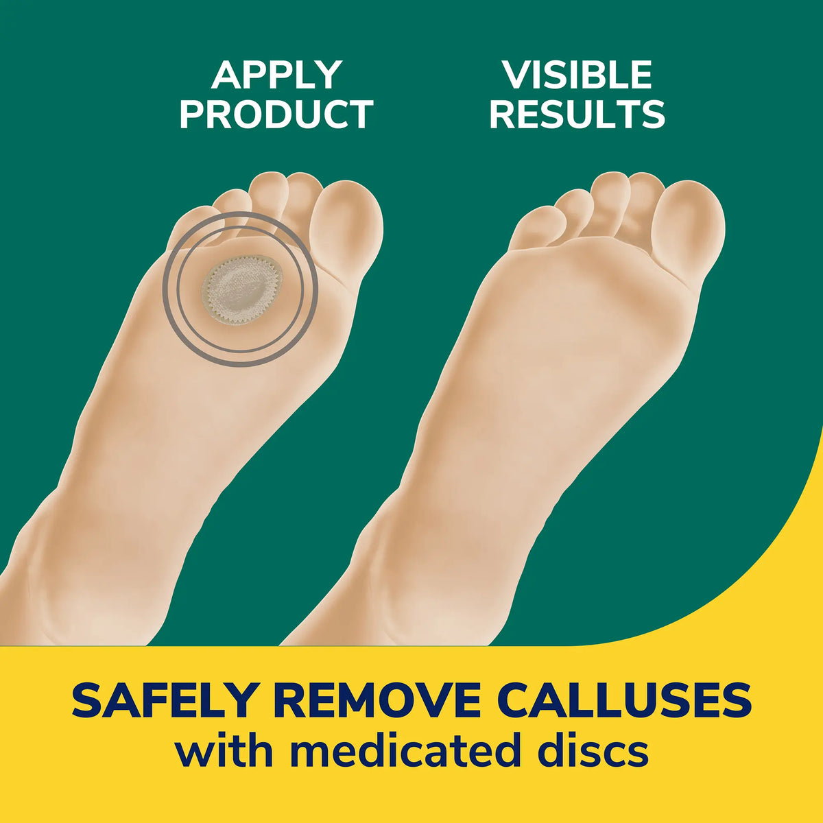Extra Thick Callus Removers