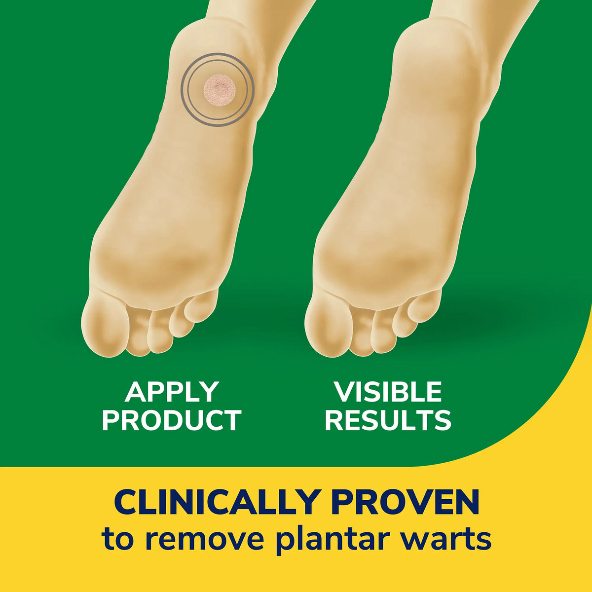Clear Away® Plantar Wart Removers